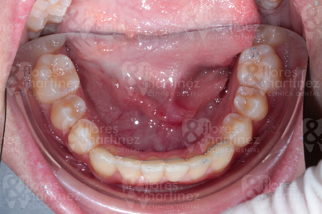 Dentadura inferior (después)