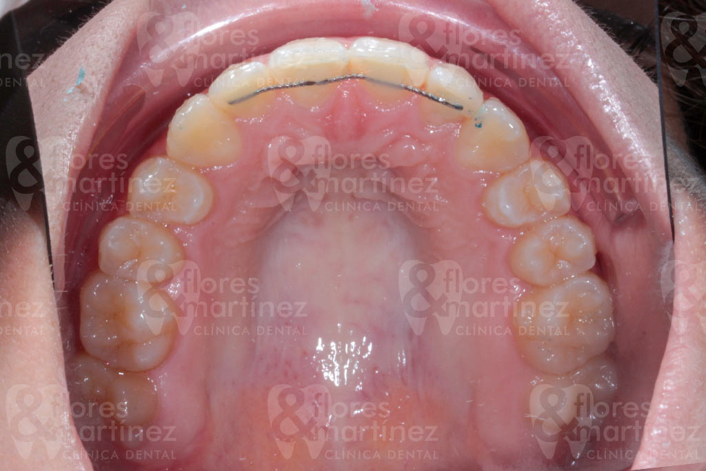 Dentadura superior (después)