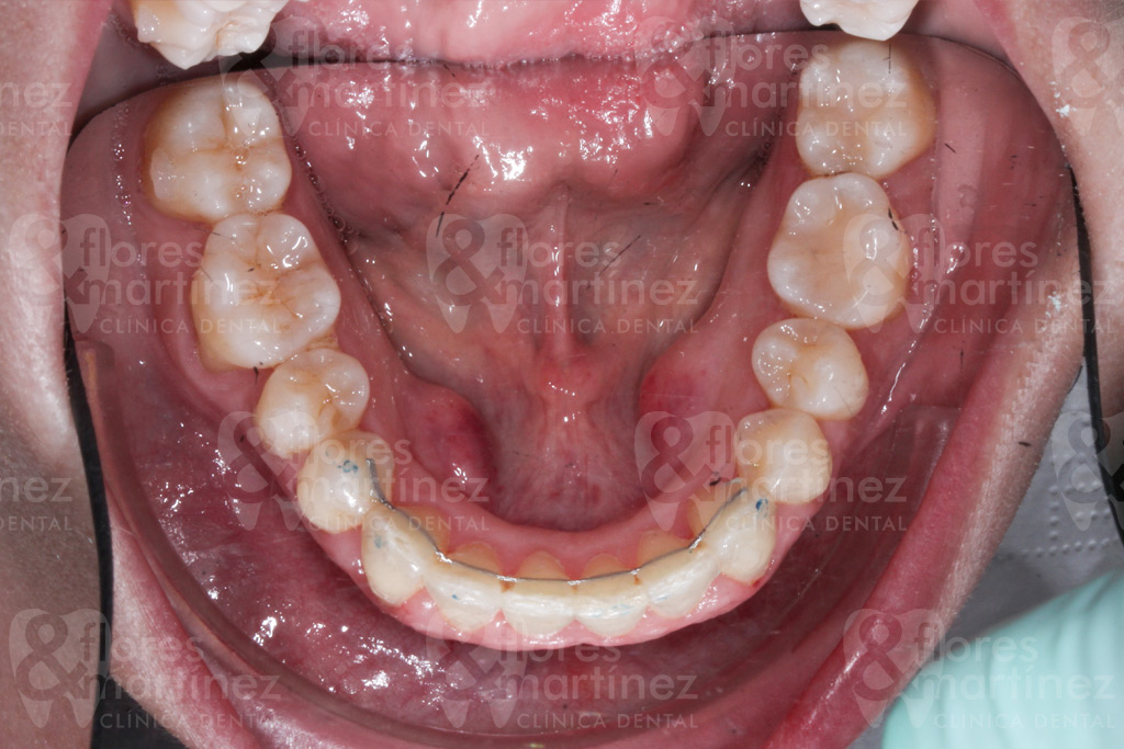 Dentadura inferior, vista desde arriba (después)